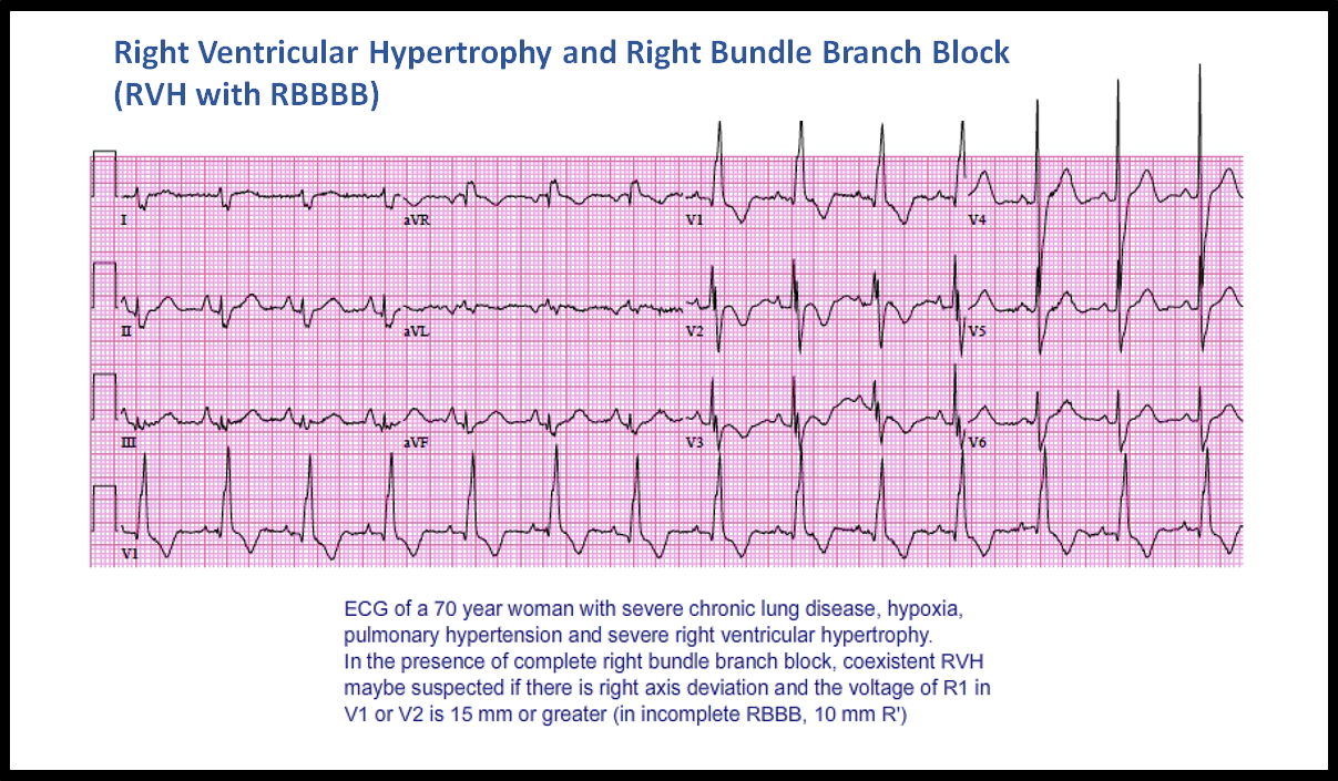 T14: Ventricular Hypertrophy - ECG Made Simple