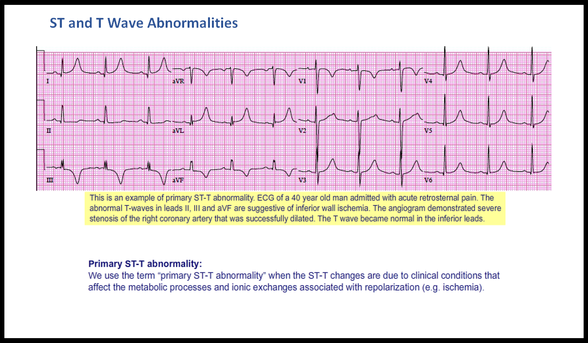 T15: ST and T Wave Abnormalities - ECG Made Simple