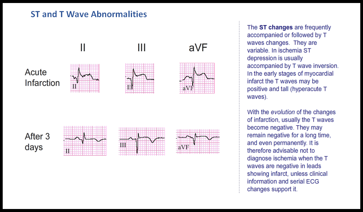 T15: ST and T Wave Abnormalities - ECG Made Simple