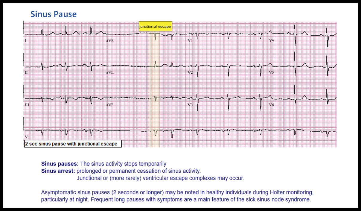 T22 Sinus Pause ECG Made Simple