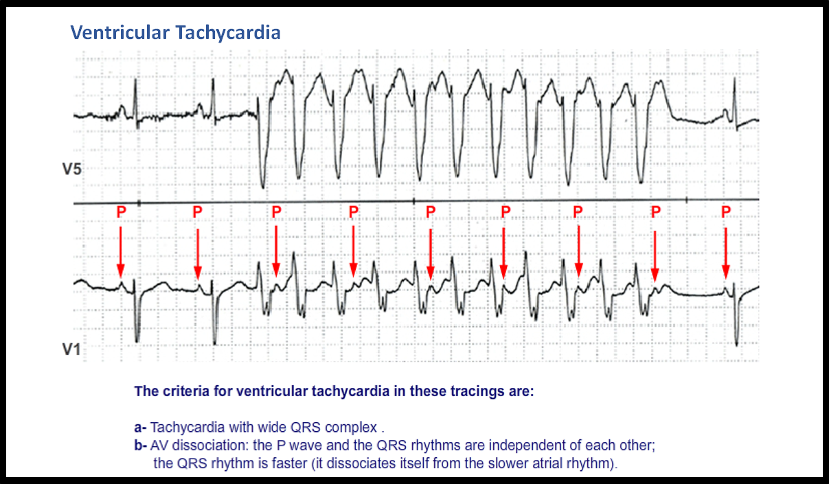 T39: Ventricular Tachycardia - ECG Made Simple