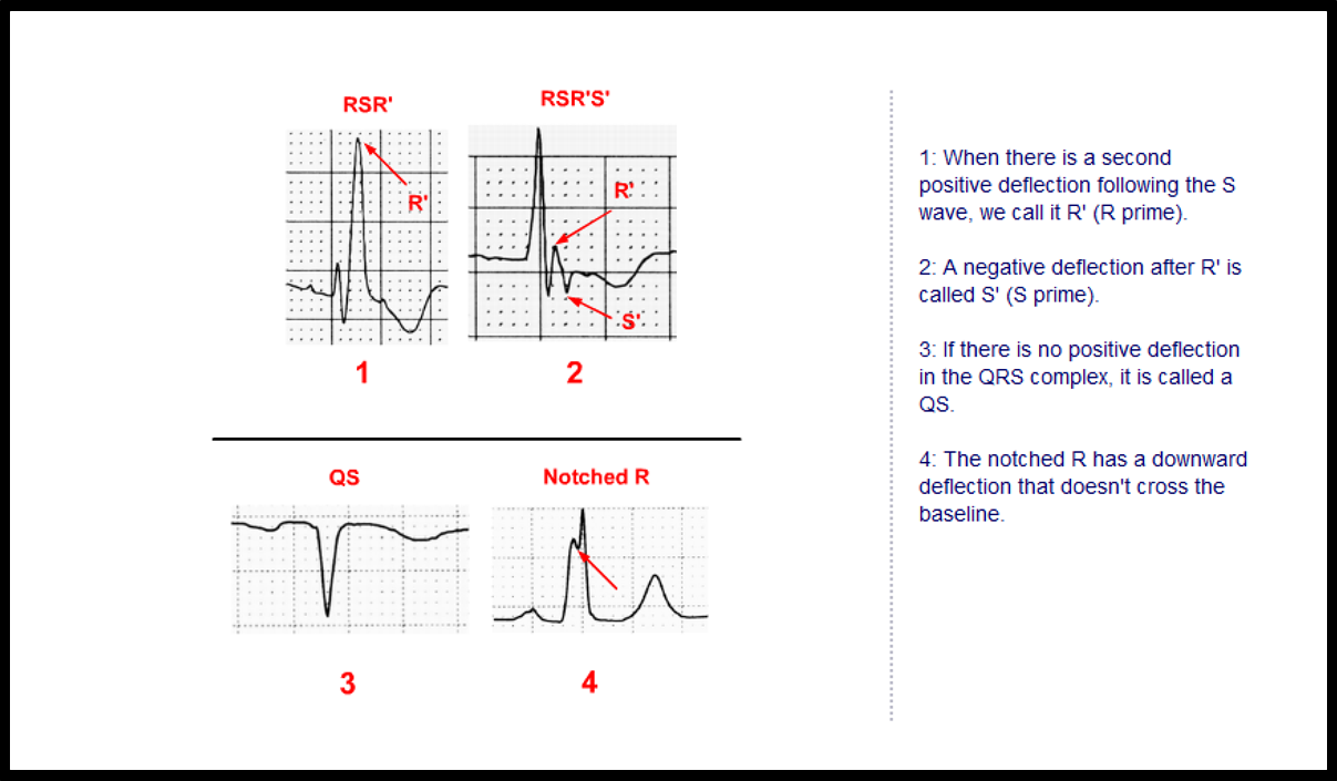 T4: Waves and Intervals - ECG Made Simple